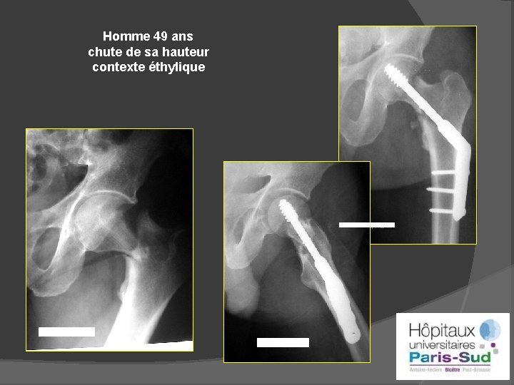 Homme 49 ans chute de sa hauteur contexte éthylique 