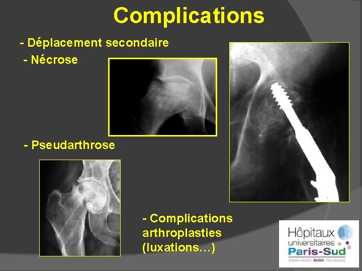 Complications - Déplacement secondaire - Nécrose - Pseudarthrose - Complications arthroplasties (luxations…) 