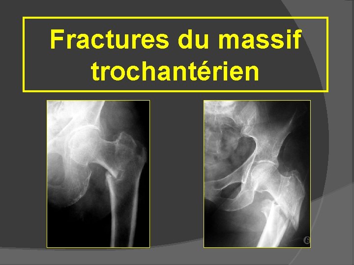 Fractures du massif trochantérien 