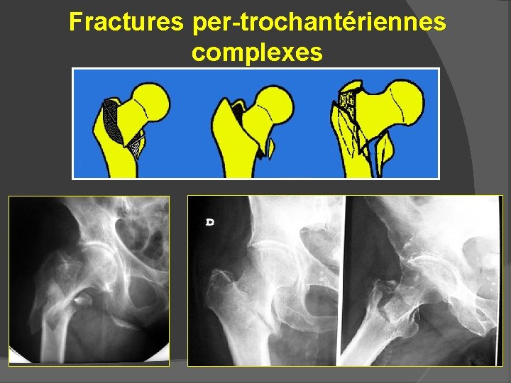 TRAUMATISME DE LA HANCHE PRINCIPES DE LA PRISE traumatisme-de-la-hanche-principes-de-la-prise