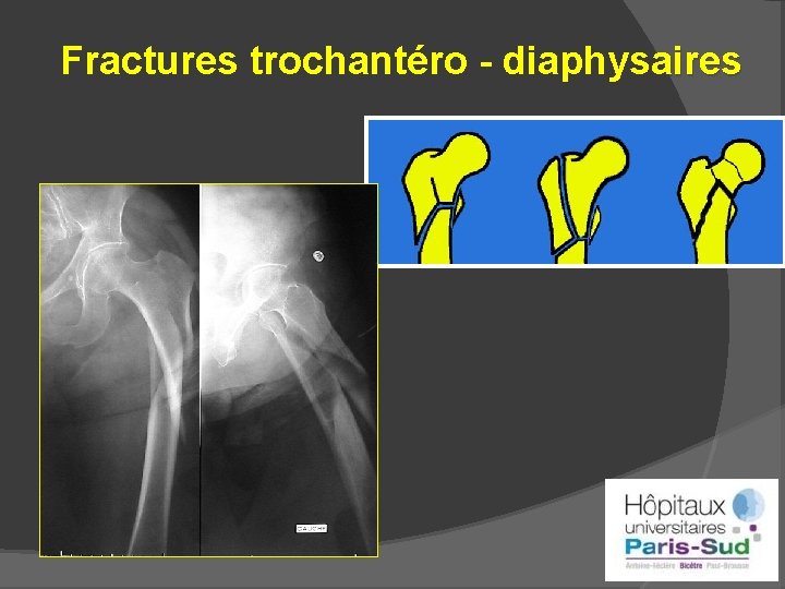 Fractures trochantéro - diaphysaires 