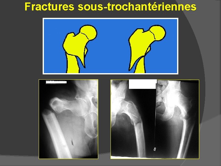 Fractures sous-trochantériennes 