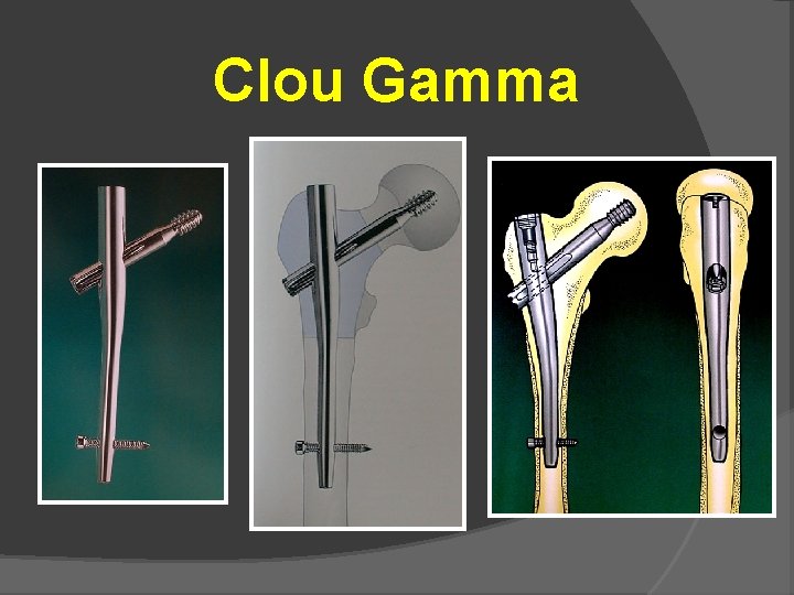 Clou Gamma 