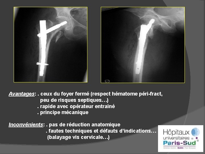 Avantages: . ceux du foyer fermé (respect hématome péri-fract, peu de risques septiques…) .