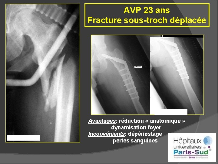AVP 23 ans Fracture sous-troch déplacée Avantages: réduction « anatomique » dynamisation foyer Inconvénients: