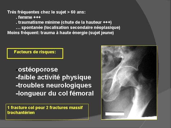 Très fréquentes chez le sujet > 60 ans: . femme +++. traumatisme minime (chute