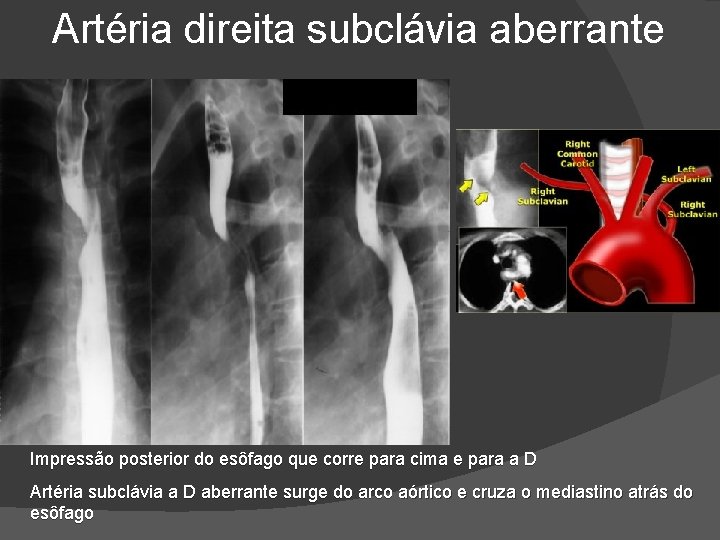 Artéria direita subclávia aberrante Impressão posterior do esôfago que corre para cima e para Artéria direita subclávia aberrante Impressão posterior do esôfago que corre para cima e para