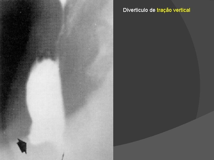 Diverticulo de tração vertical Diverticulo de tração vertical