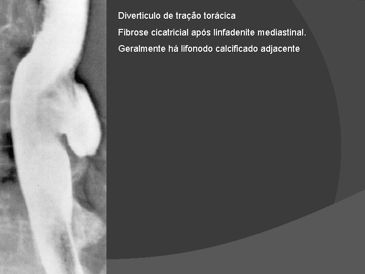 Diverticulo de tração torácica Fibrose cicatricial após linfadenite mediastinal. Geralmente há lifonodo calcificado adjacente Diverticulo de tração torácica Fibrose cicatricial após linfadenite mediastinal. Geralmente há lifonodo calcificado adjacente