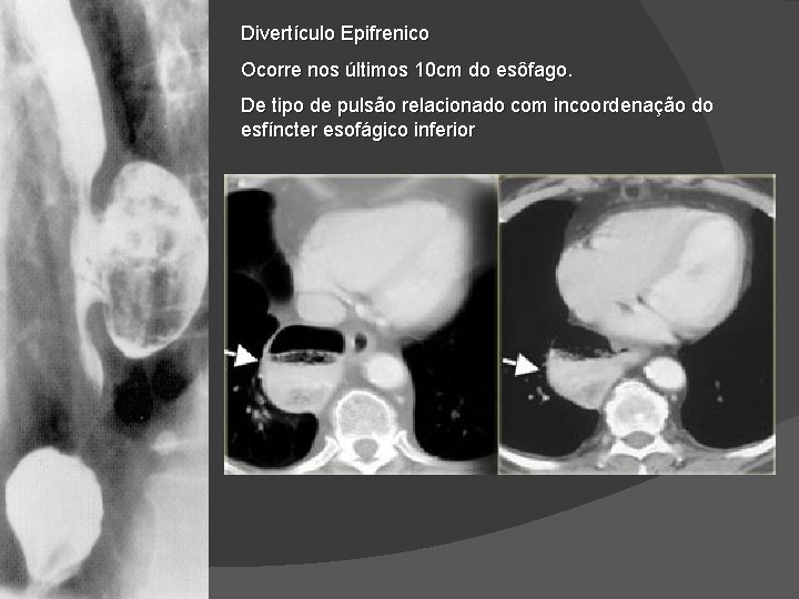 Divertículo Epifrenico Ocorre nos últimos 10 cm do esôfago. De tipo de pulsão relacionado Divertículo Epifrenico Ocorre nos últimos 10 cm do esôfago. De tipo de pulsão relacionado