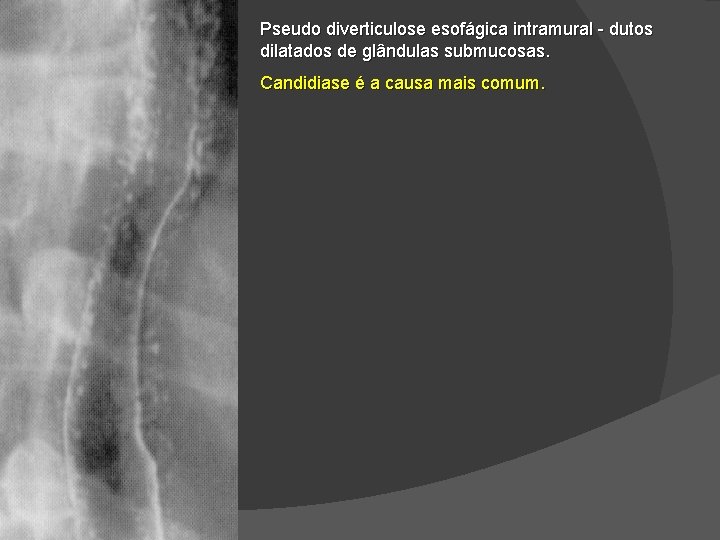 Pseudo diverticulose esofágica intramural - dutos dilatados de glândulas submucosas. Candidiase é a causa Pseudo diverticulose esofágica intramural - dutos dilatados de glândulas submucosas. Candidiase é a causa