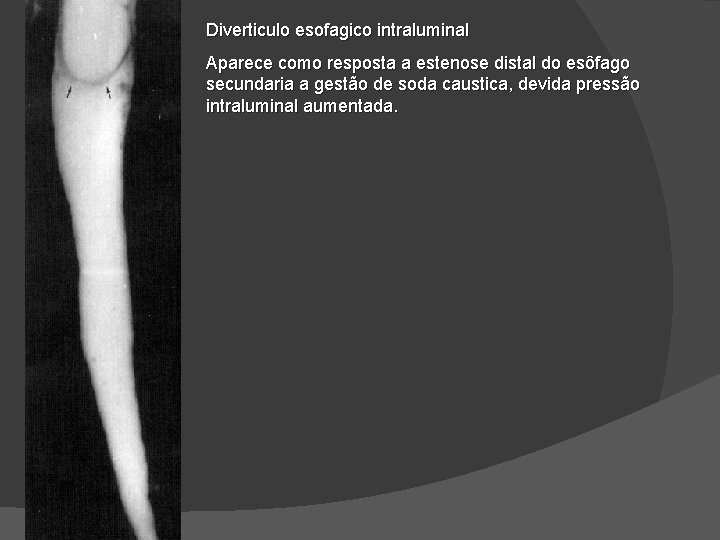 Diverticulo esofagico intraluminal Aparece como resposta a estenose distal do esôfago secundaria a gestão Diverticulo esofagico intraluminal Aparece como resposta a estenose distal do esôfago secundaria a gestão