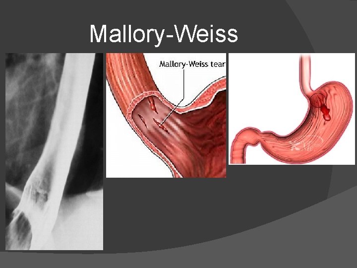 Mallory-Weiss Mallory-Weiss