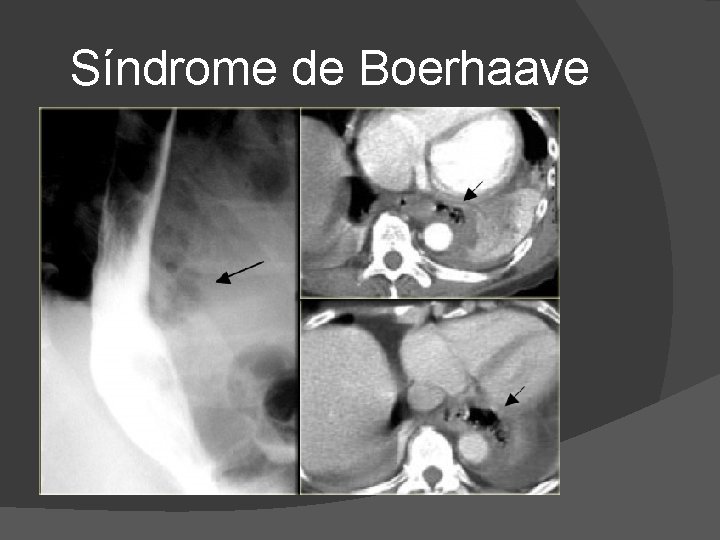 Síndrome de Boerhaave Síndrome de Boerhaave