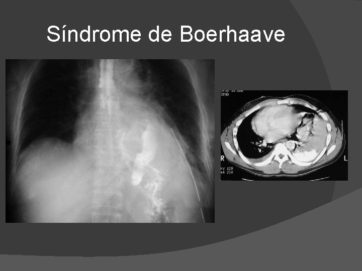 Síndrome de Boerhaave Síndrome de Boerhaave