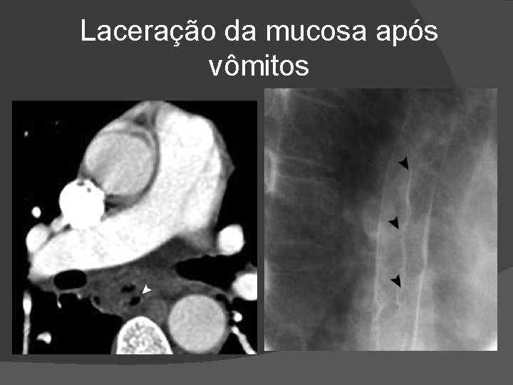 Laceração da mucosa após vômitos Laceração da mucosa após vômitos