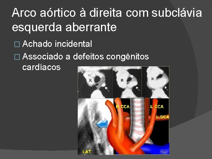 Arco aórtico à direita com subclávia esquerda aberrante � Achado incidental � Associado a Arco aórtico à direita com subclávia esquerda aberrante � Achado incidental � Associado a