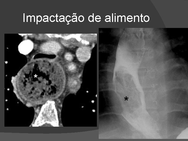 Impactação de alimento Impactação de alimento