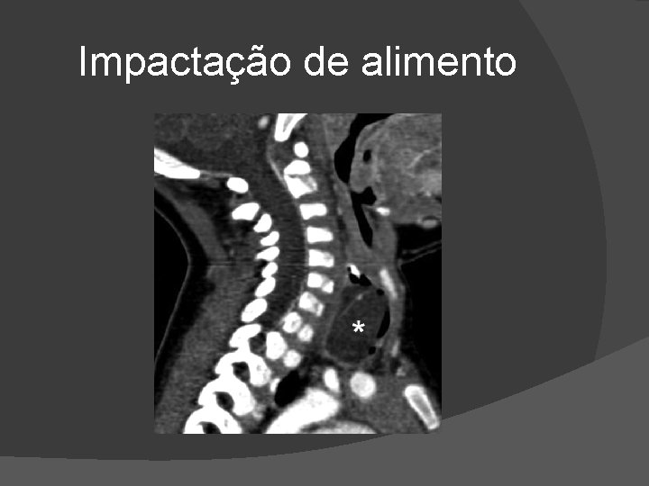 Impactação de alimento Impactação de alimento