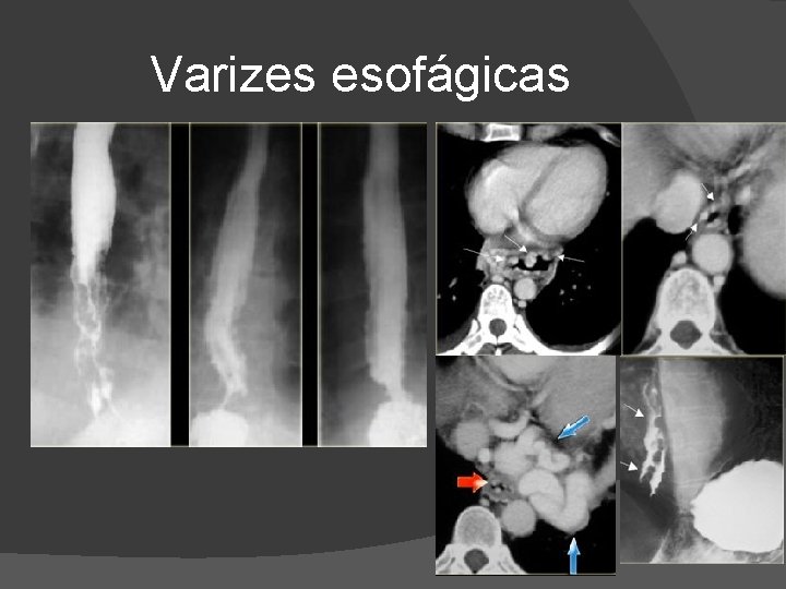 Varizes esofágicas Varizes esofágicas