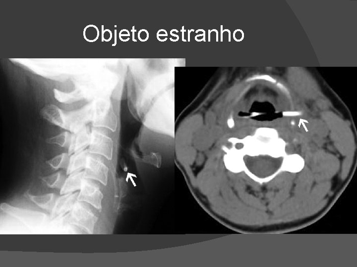 Objeto estranho Objeto estranho