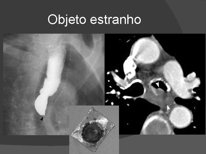 Objeto estranho Objeto estranho