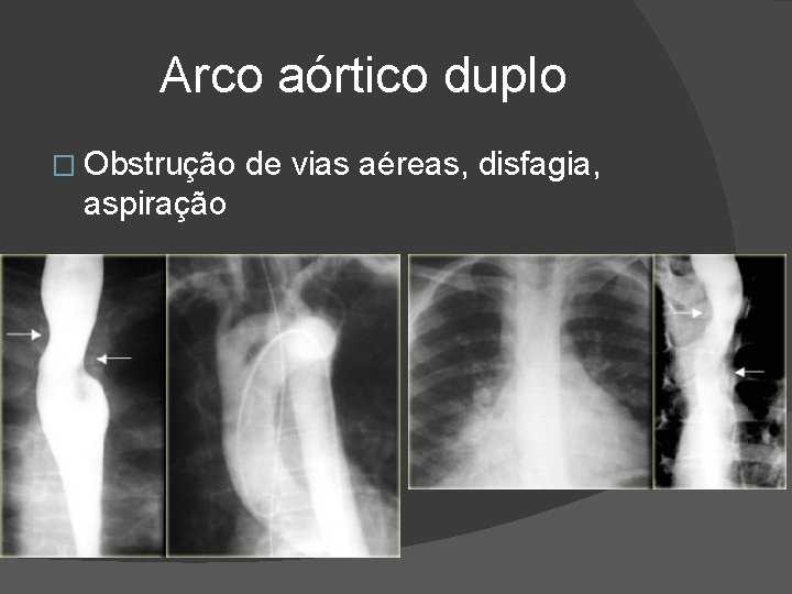 Arco aórtico duplo � Obstrução aspiração de vias aéreas, disfagia, Arco aórtico duplo � Obstrução aspiração de vias aéreas, disfagia,