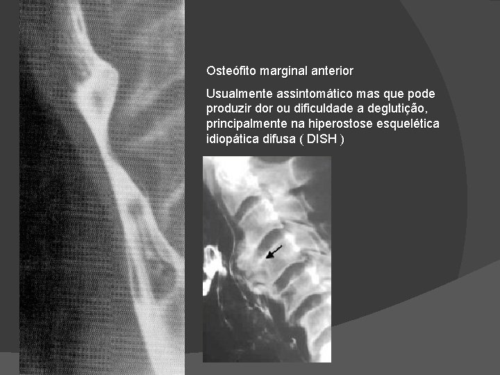 Osteófito marginal anterior Usualmente assintomático mas que pode produzir dor ou dificuldade a deglutição, Osteófito marginal anterior Usualmente assintomático mas que pode produzir dor ou dificuldade a deglutição,
