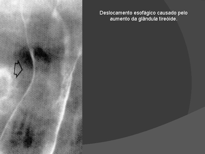Deslocamento esofágico causado pelo aumento da glândula tireóide. Deslocamento esofágico causado pelo aumento da glândula tireóide.