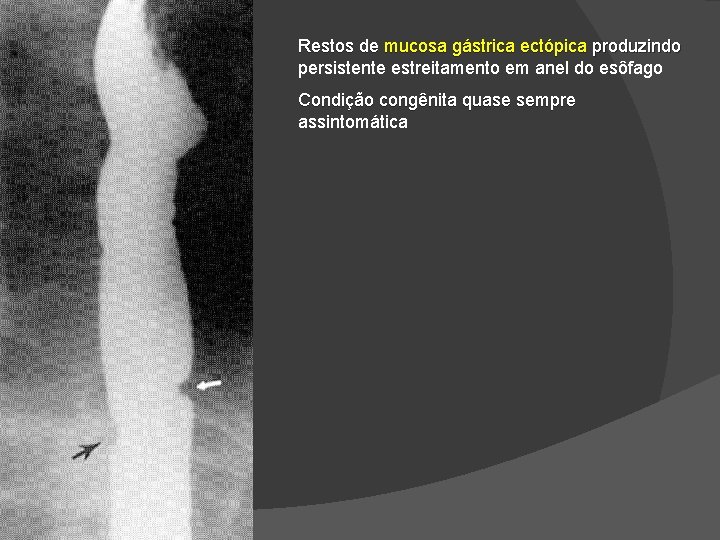 Restos de mucosa gástrica ectópica produzindo persistente estreitamento em anel do esôfago Condição congênita Restos de mucosa gástrica ectópica produzindo persistente estreitamento em anel do esôfago Condição congênita