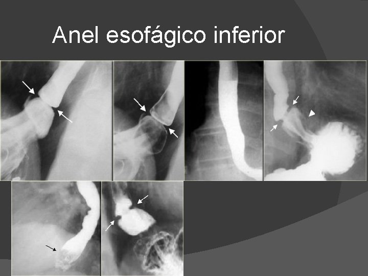 Anel esofágico inferior Anel esofágico inferior