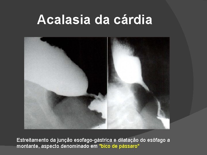 Acalasia da cárdia Estreitamento da junção esofago-gástrica e dilatação do esôfago a montante, aspecto Acalasia da cárdia Estreitamento da junção esofago-gástrica e dilatação do esôfago a montante, aspecto
