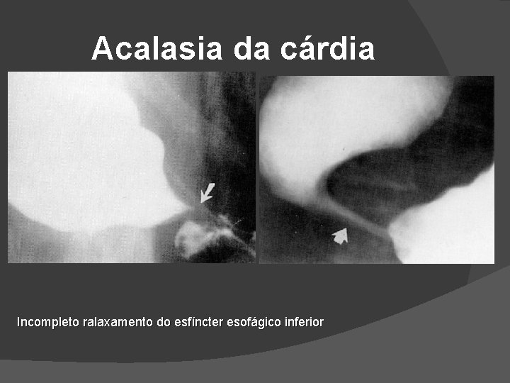 Acalasia da cárdia Incompleto ralaxamento do esfíncter esofágico inferior Acalasia da cárdia Incompleto ralaxamento do esfíncter esofágico inferior