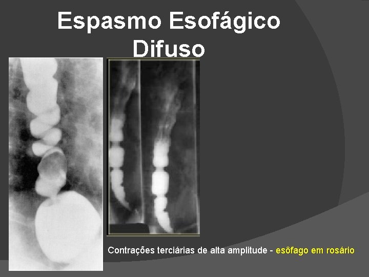 Espasmo Esofágico Difuso Contrações terciárias de alta amplitude - esôfago em rosário Espasmo Esofágico Difuso Contrações terciárias de alta amplitude - esôfago em rosário