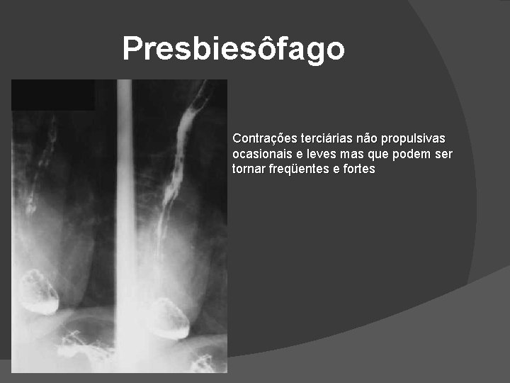 Presbiesôfago Contrações terciárias não propulsivas ocasionais e leves mas que podem ser tornar freqüentes Presbiesôfago Contrações terciárias não propulsivas ocasionais e leves mas que podem ser tornar freqüentes
