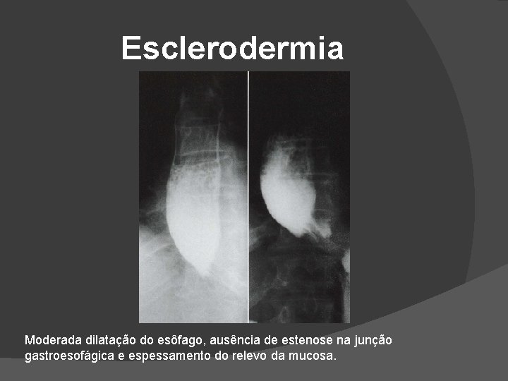 Esclerodermia Moderada dilatação do esôfago, ausência de estenose na junção gastroesofágica e espessamento do Esclerodermia Moderada dilatação do esôfago, ausência de estenose na junção gastroesofágica e espessamento do