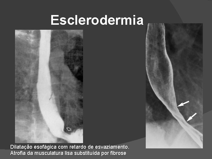 Esclerodermia Dilatação esofágica com retardo de esvaziamento. Atrofia da musculatura lisa substituída por fibrose Esclerodermia Dilatação esofágica com retardo de esvaziamento. Atrofia da musculatura lisa substituída por fibrose