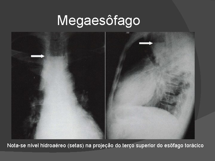 Megaesôfago Nota-se nível hidroaéreo (setas) na projeção do terço superior do esôfago torácico Megaesôfago Nota-se nível hidroaéreo (setas) na projeção do terço superior do esôfago torácico