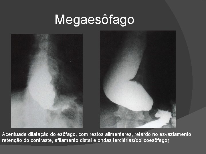 Megaesôfago Acentuada dilatação do esôfago, com restos alimentares, retardo no esvaziamento, retenção do contraste, Megaesôfago Acentuada dilatação do esôfago, com restos alimentares, retardo no esvaziamento, retenção do contraste,