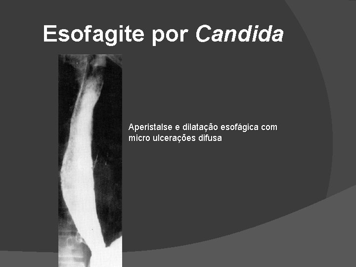 Esofagite por Candida Aperistalse e dilatação esofágica com micro ulcerações difusa Esofagite por Candida Aperistalse e dilatação esofágica com micro ulcerações difusa