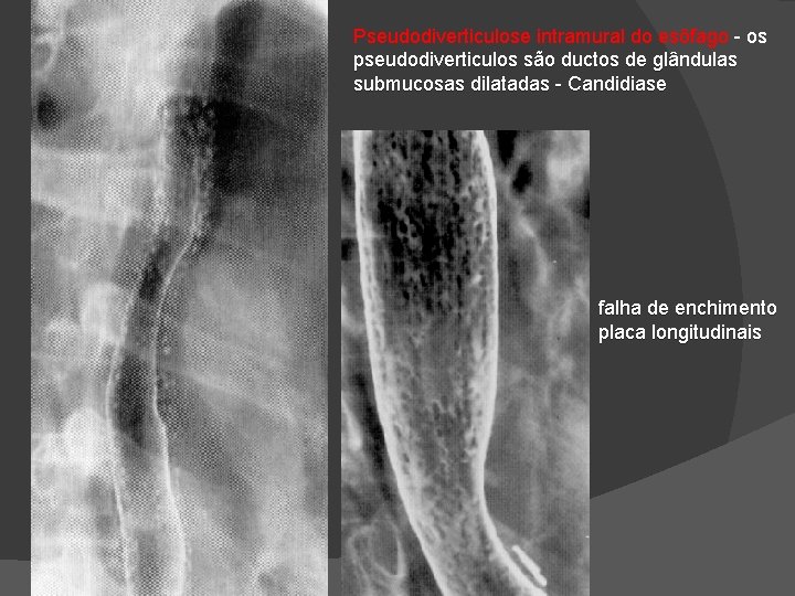 Pseudodiverticulose intramural do esôfago - os pseudodiverticulos são ductos de glândulas submucosas dilatadas - Pseudodiverticulose intramural do esôfago - os pseudodiverticulos são ductos de glândulas submucosas dilatadas -