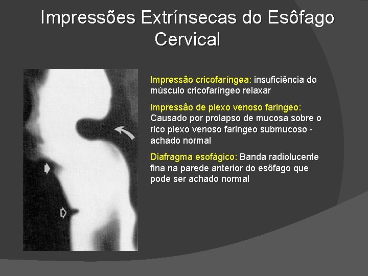 Impressões Extrínsecas do Esôfago Cervical Impressão cricofaríngea: insuficiência do músculo cricofaríngeo relaxar Impressão de Impressões Extrínsecas do Esôfago Cervical Impressão cricofaríngea: insuficiência do músculo cricofaríngeo relaxar Impressão de