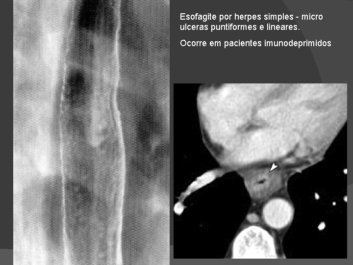 Esofagite por herpes simples - micro ulceras puntiformes e lineares. Ocorre em pacientes imunodeprimidos Esofagite por herpes simples - micro ulceras puntiformes e lineares. Ocorre em pacientes imunodeprimidos