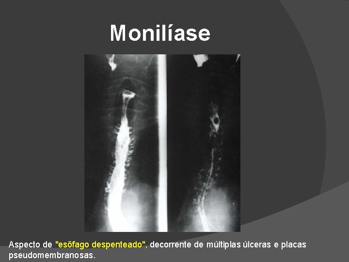 Monilíase Aspecto de "esôfago despenteado", decorrente de múltiplas úlceras e placas pseudomembranosas. Monilíase Aspecto de "esôfago despenteado", decorrente de múltiplas úlceras e placas pseudomembranosas.