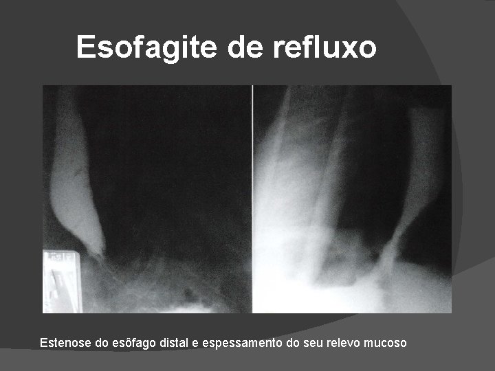 Esofagite de refluxo Estenose do esôfago distal e espessamento do seu relevo mucoso Esofagite de refluxo Estenose do esôfago distal e espessamento do seu relevo mucoso