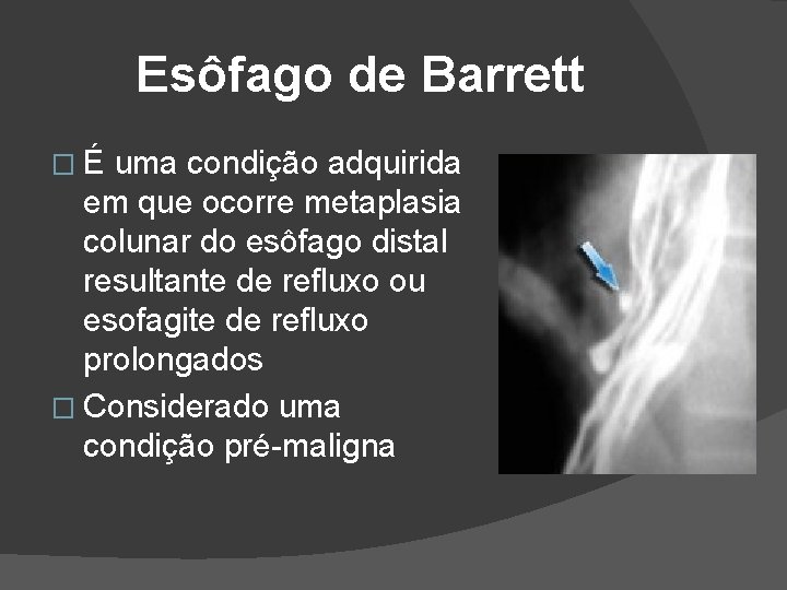 Esôfago de Barrett �É uma condição adquirida em que ocorre metaplasia colunar do esôfago Esôfago de Barrett �É uma condição adquirida em que ocorre metaplasia colunar do esôfago