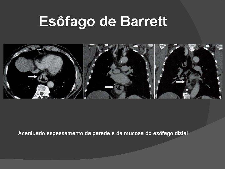 Esôfago de Barrett Acentuado espessamento da parede e da mucosa do esôfago distal Esôfago de Barrett Acentuado espessamento da parede e da mucosa do esôfago distal