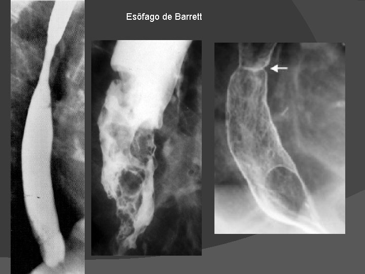 Esôfago de Barrett Esôfago de Barrett