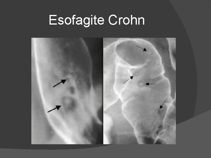 Esofagite Crohn Esofagite Crohn
