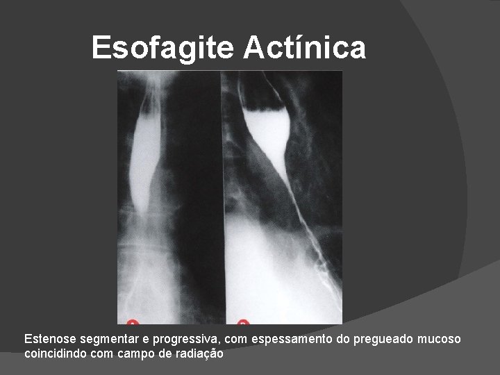 Esofagite Actínica Estenose segmentar e progressiva, com espessamento do pregueado mucoso coincidindo com campo Esofagite Actínica Estenose segmentar e progressiva, com espessamento do pregueado mucoso coincidindo com campo
